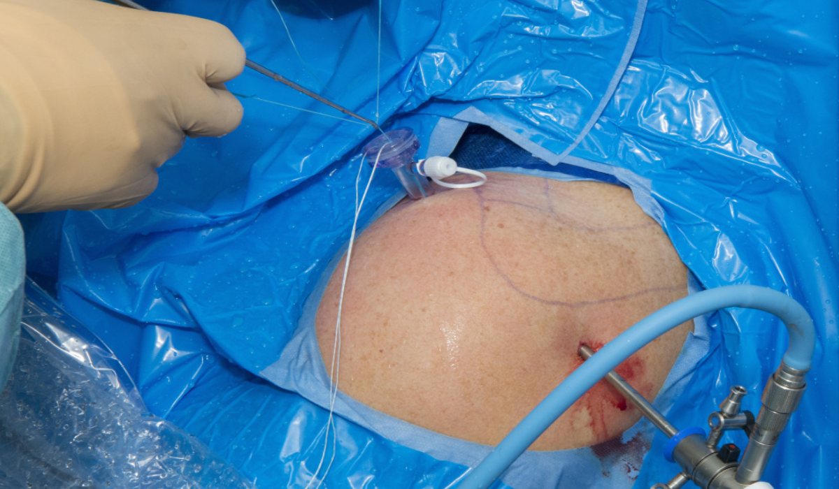 نحوه انجام عمل آرتروسکوپی شانه