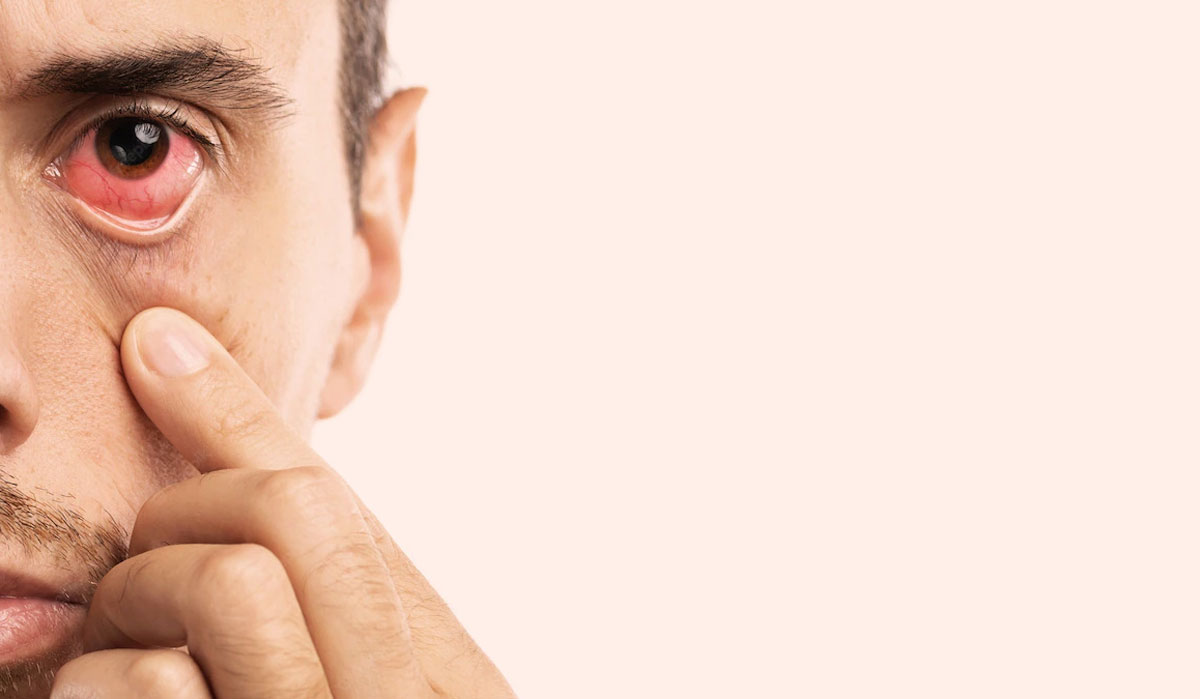 قرمزشدن چشم