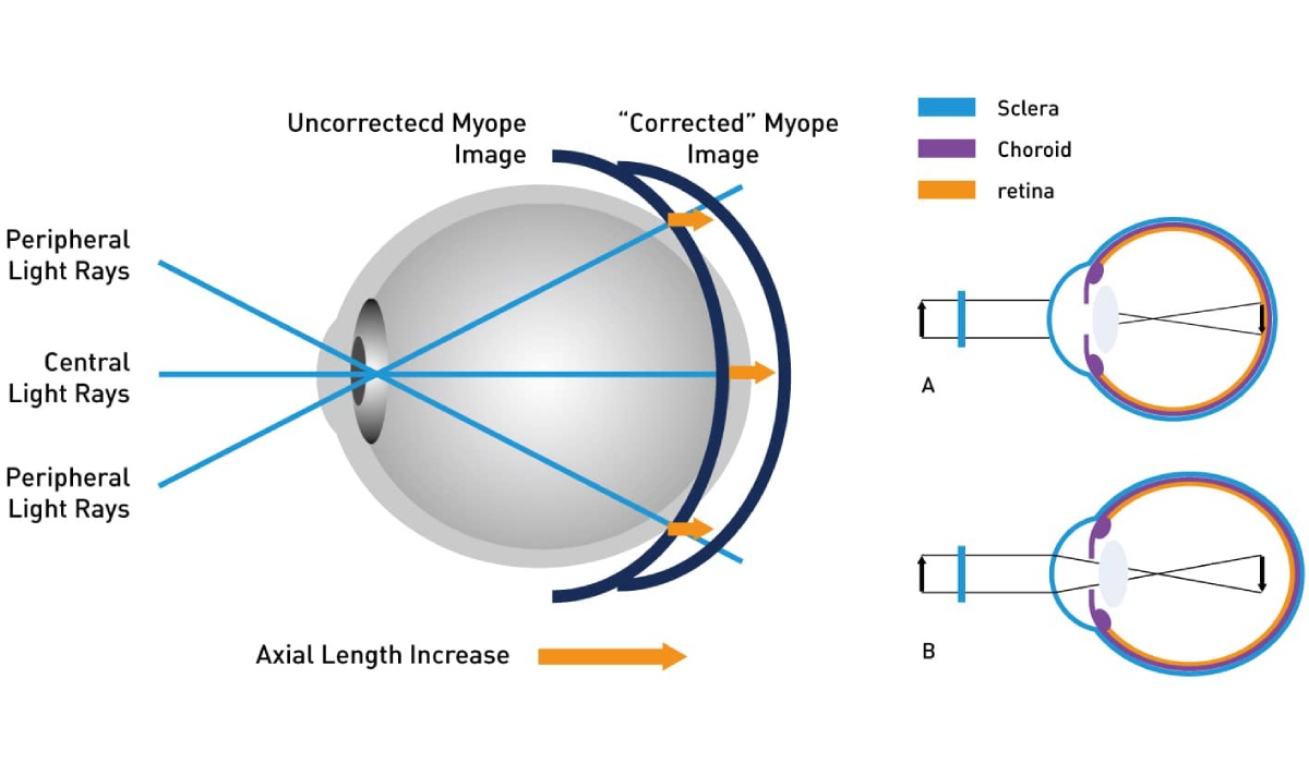 کارکرد عینک بلوکات یا بلوکنترل