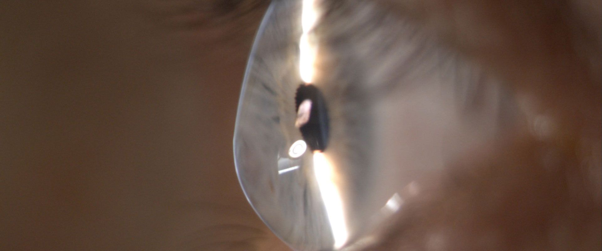 قوز قرنیه چشم