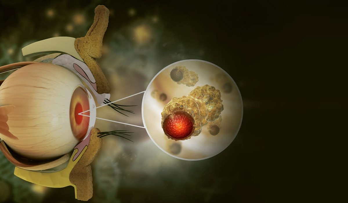 عمل جراحی سرطان چشم