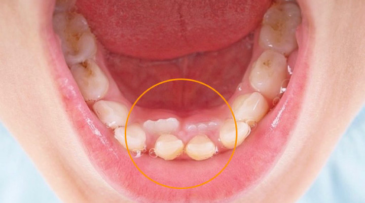 دندان اضافی از علائم سندرم گاردنر