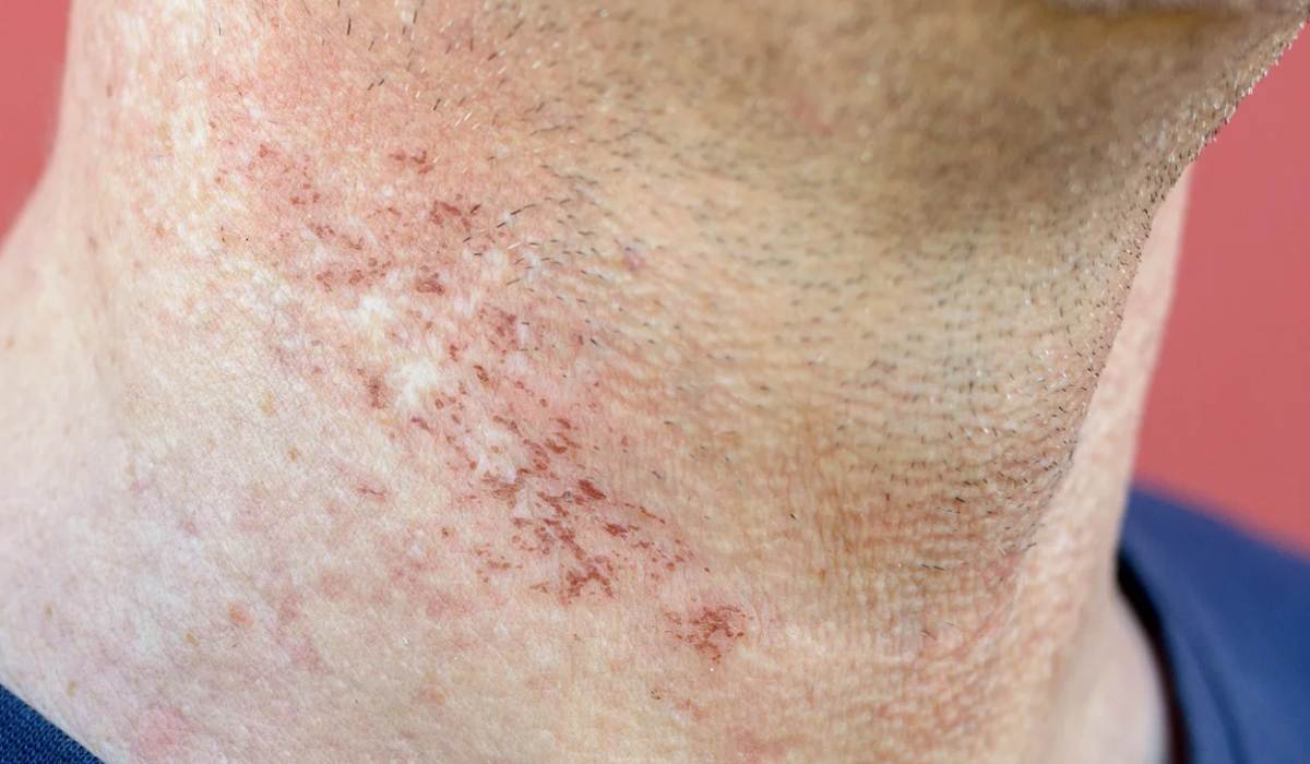 لیزر موهای زائد | مزایا، انواع و قیمت لیزر موهای زائد_رنگو 19 عوارض لیزر موهای زائد