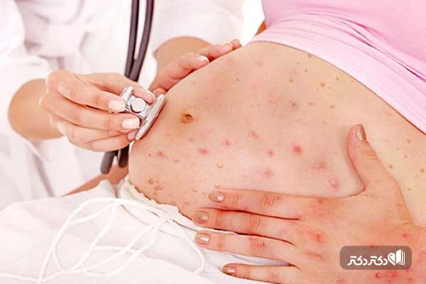 ابله مرغان در بارداری 