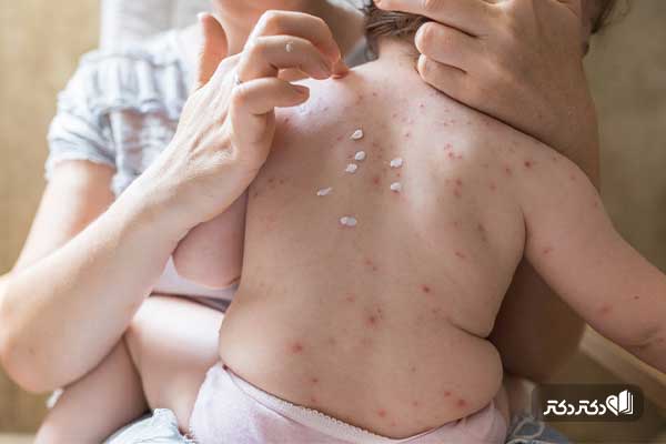 تاول های آبله مرغان