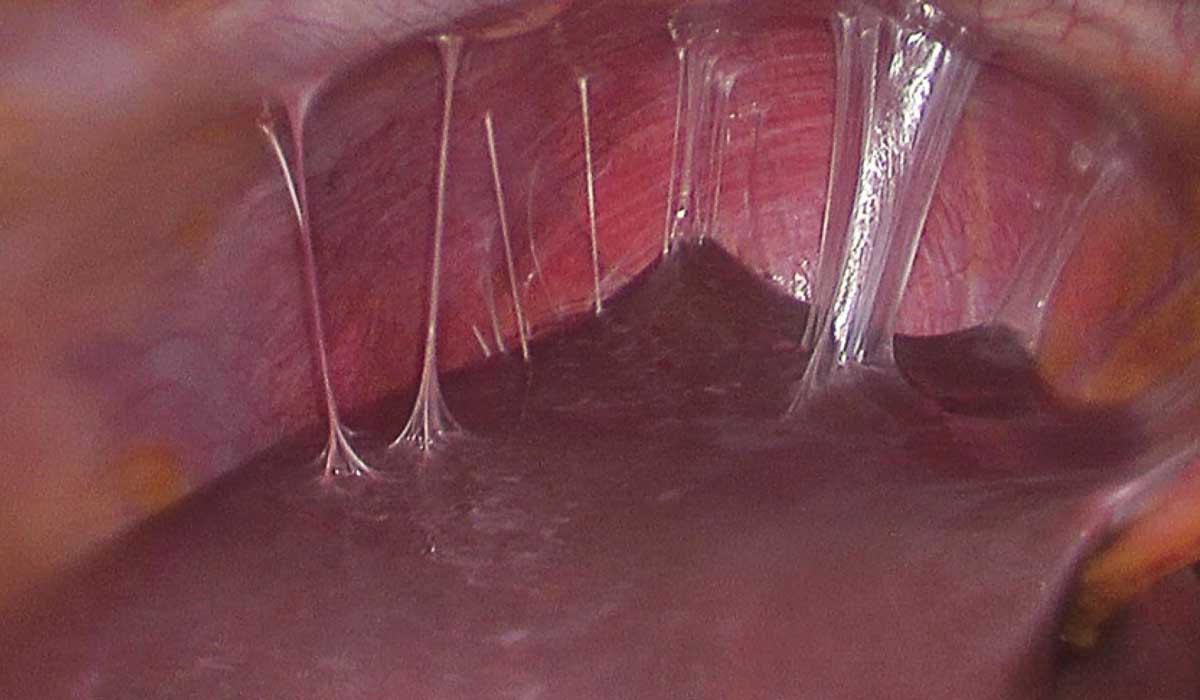 6 علامت و 10 درمان سریع خانگی و پزشکی_رنگو 42 درمان سرفه خلط دار چیست