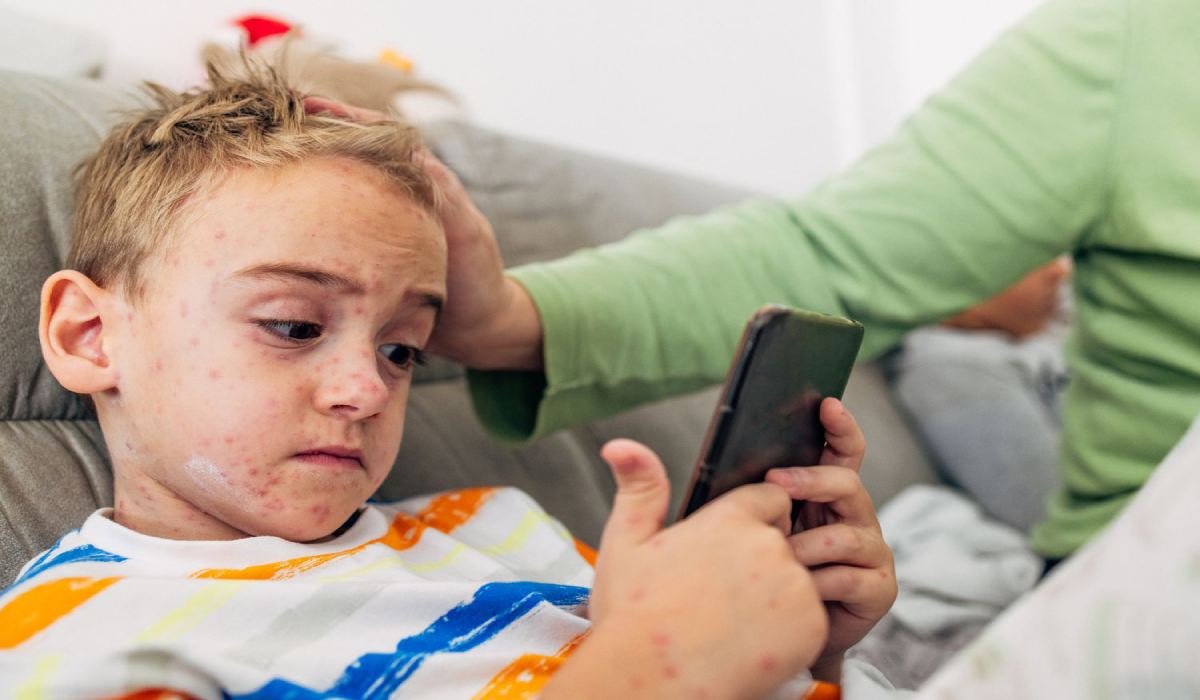 مرحله های، علائم، تشخیص و درمان آبله مرغان_رنگو 52 کودک مبتلا به بیحالی ناشی از بیماری آبله مرغان