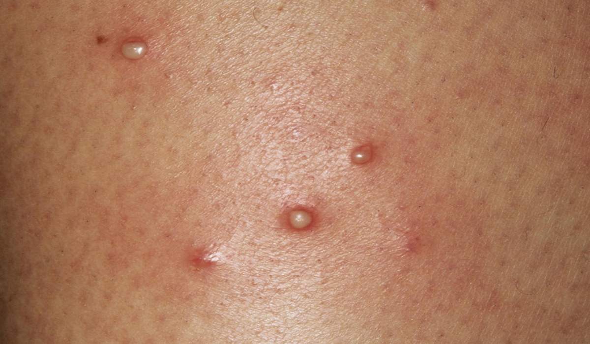 مرحله های، علائم، تشخیص و درمان آبله مرغان_رنگو 56 عکس راشهای تبدیل شده به تاولهای پر از مایع در بیماری آبله مرغان