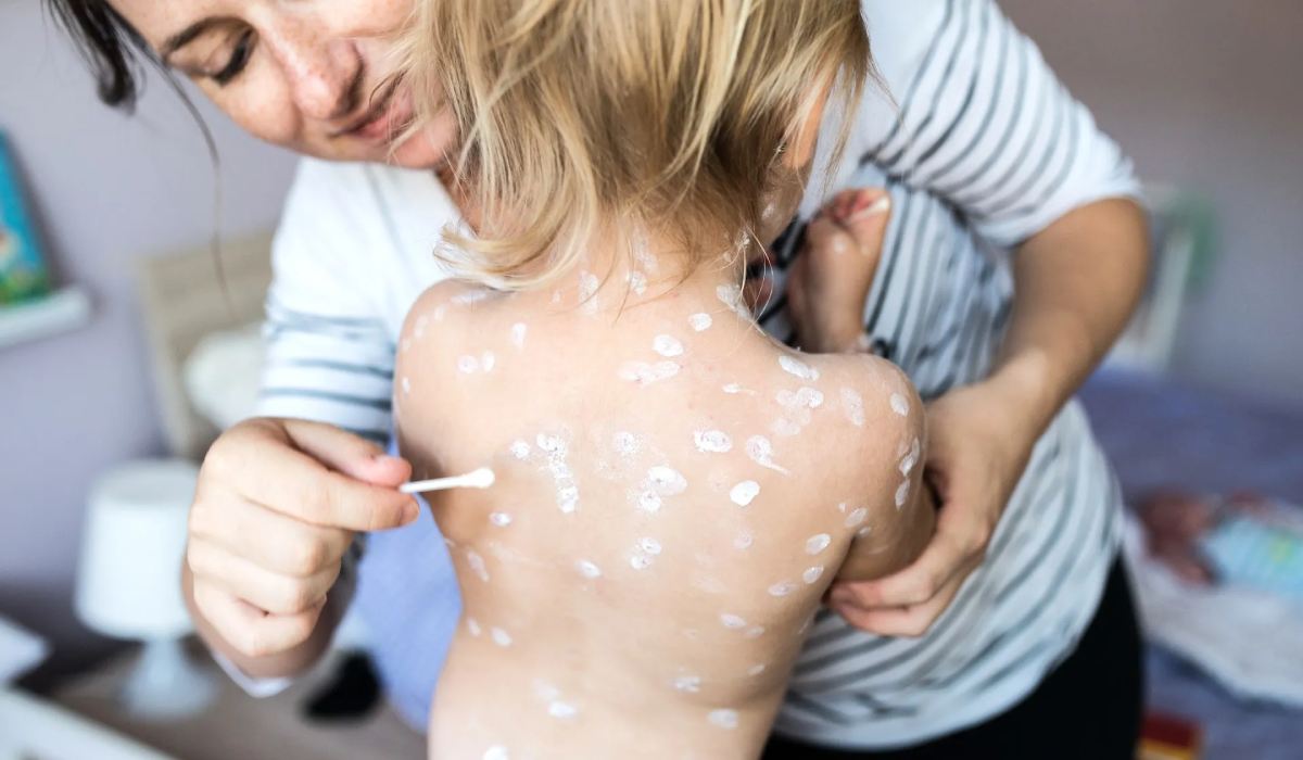 مرحله های، علائم، تشخیص و درمان آبله مرغان_رنگو 66 استفاده از لوسیون کالامین برای تسکین خارش بیماری آبله مرغان