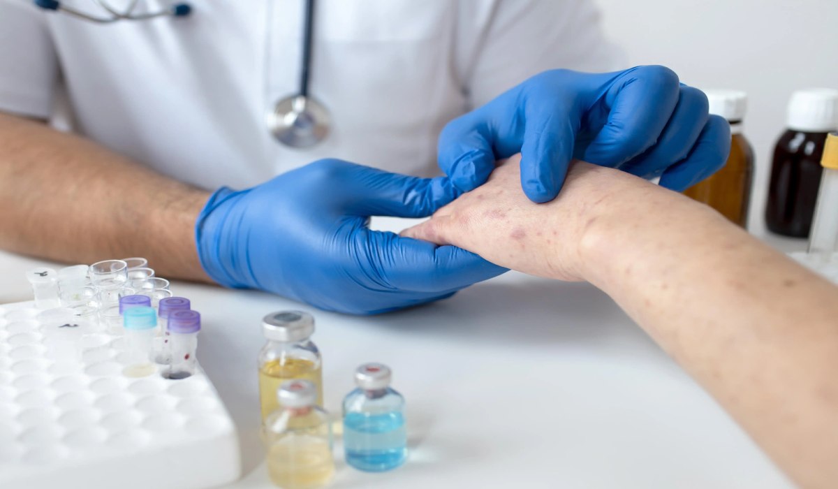 مرحله های، علائم، تشخیص و درمان آبله مرغان_رنگو 62 پزشک در حال معاینه فیزیکی بیمار برای تشخیص بیماری آبله مرغان