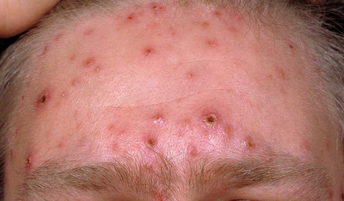 مرحله های، علائم، تشخیص و درمان آبله مرغان_رنگو 54 شکل جوشهای ابله مرغان عکس