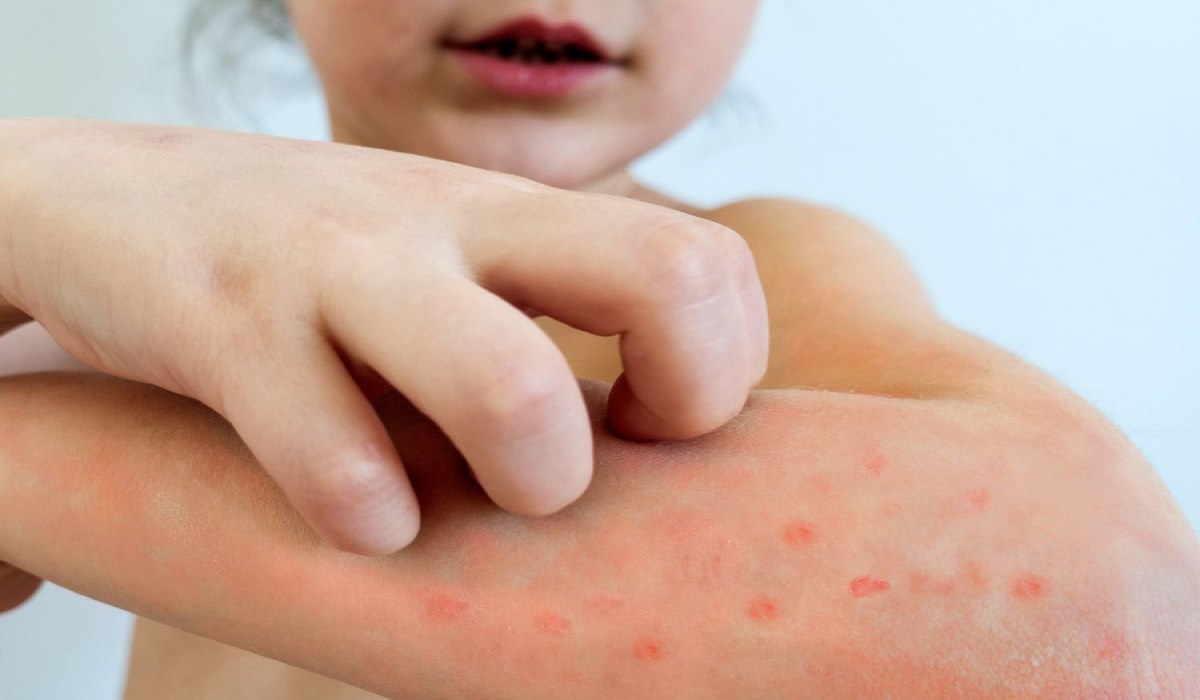 مرحله های، علائم، تشخیص و درمان آبله مرغان_رنگو 70 اجتناب از خاراندن تاولهای ناشی از آبله مرغان