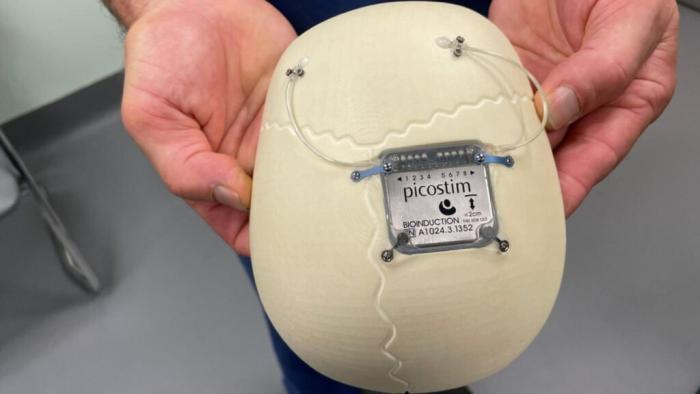 ایمپلنت مغزی در مغز یک نوجوان به کاهش تشنج شدید کمک کرد