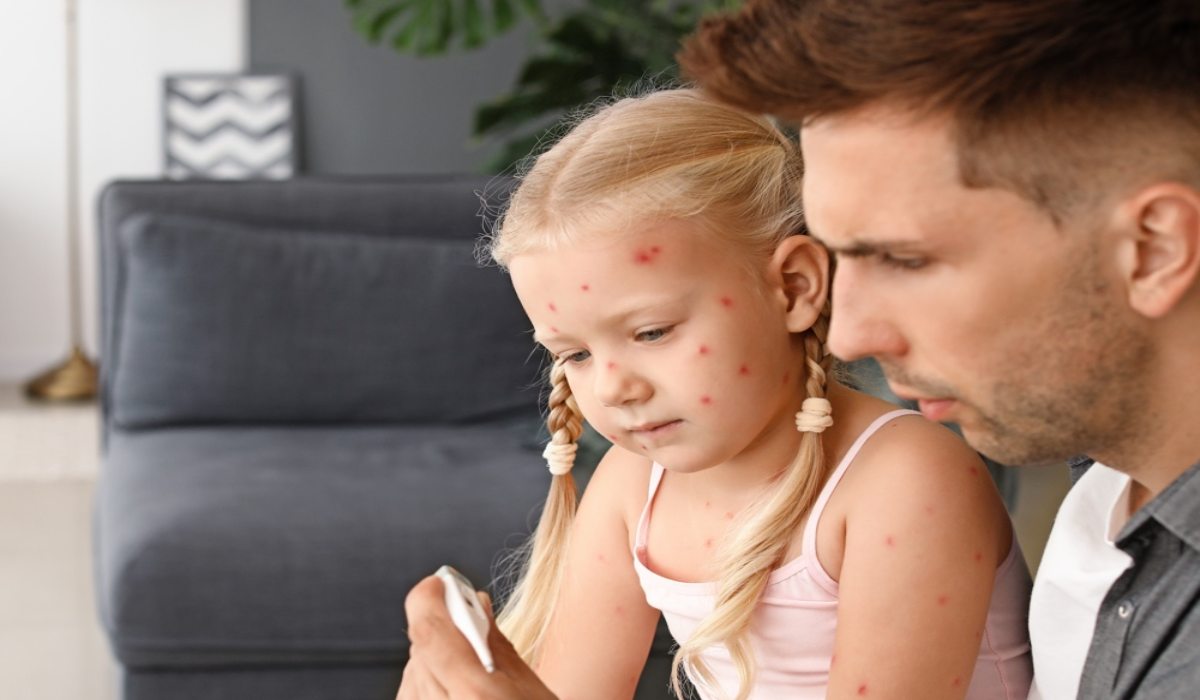 اندازه‌گیری کودک مبتلا به بیماری آبله مرغان