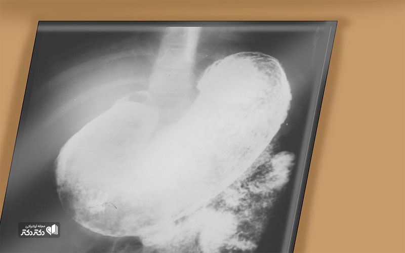 درمان گاستریت