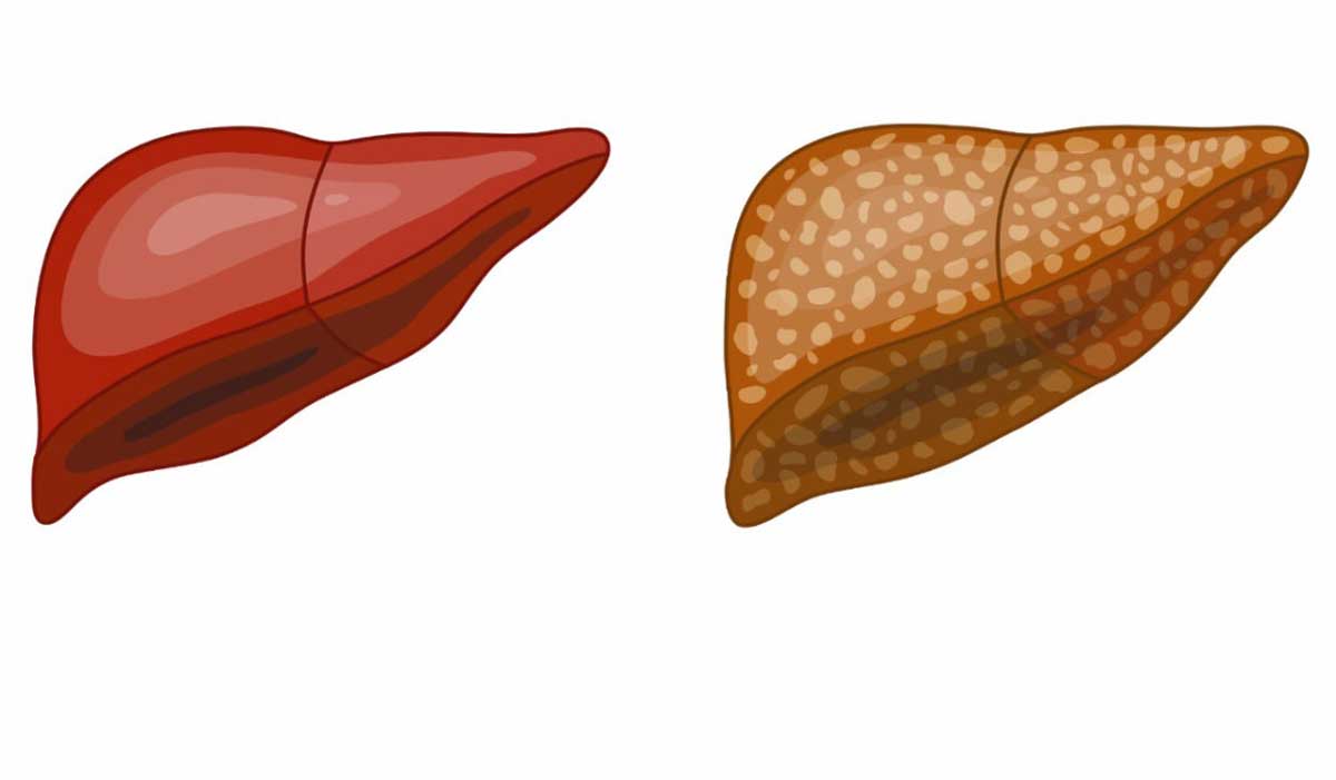 علت کبد چرب