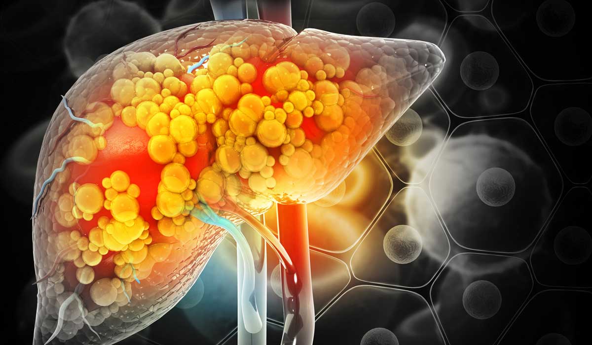 درمان کبد چرب