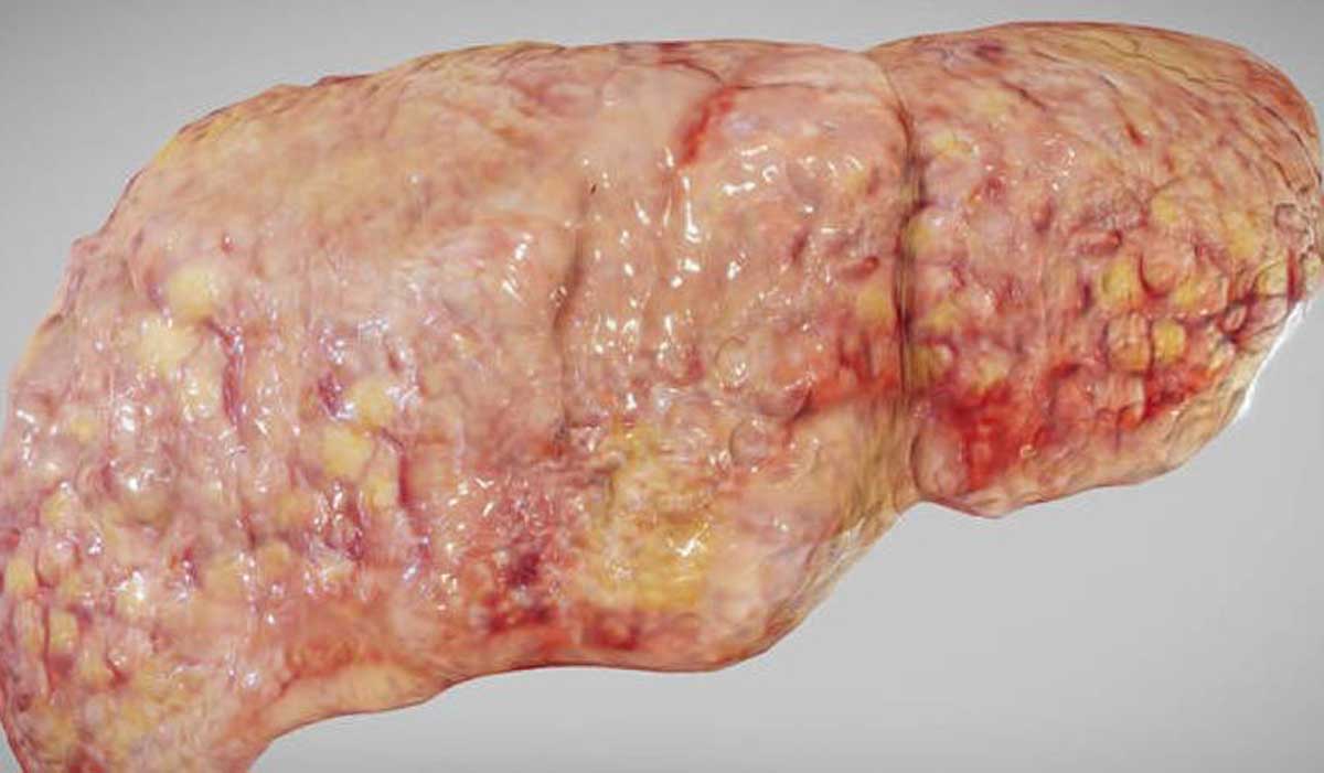 کبد چرب‌شده