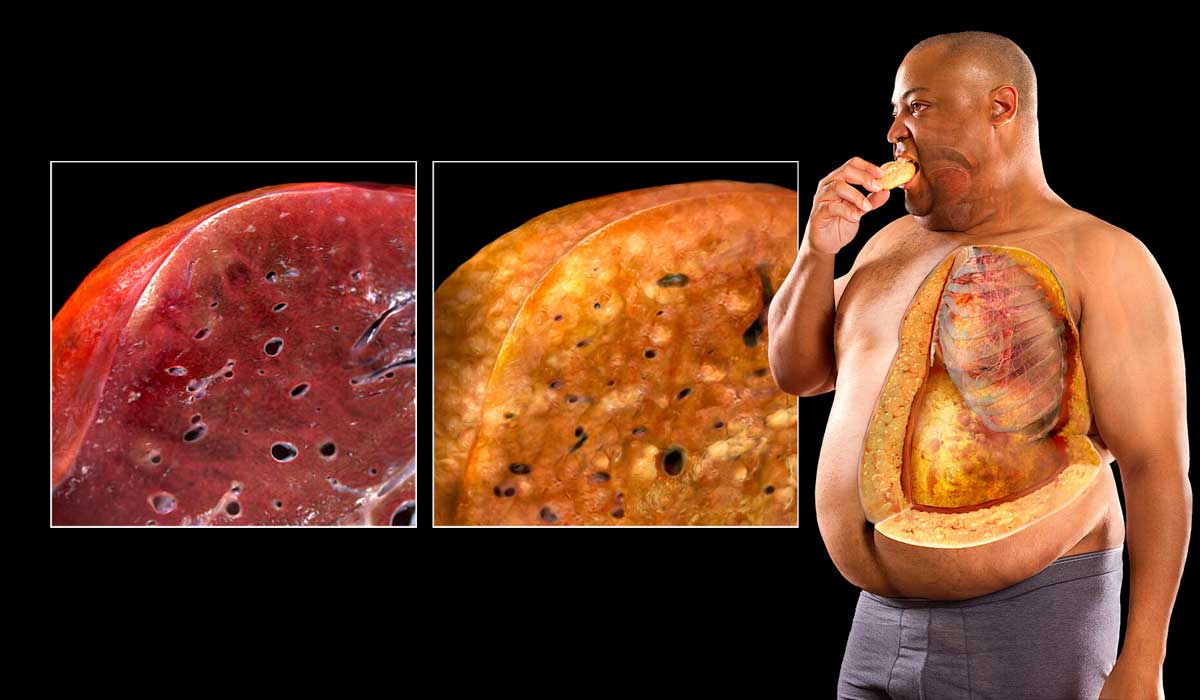 ارتباط کبد چرب با بیماری‌های دیگر