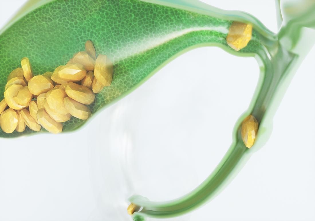 درمان سنگ صفرا با طب سنتی_رنگو 34 درمان سنگ صفرا