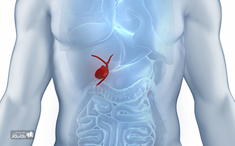 درمان سنگ صفرا با طب سنتی_رنگو 42 درمان سنگ صفرا