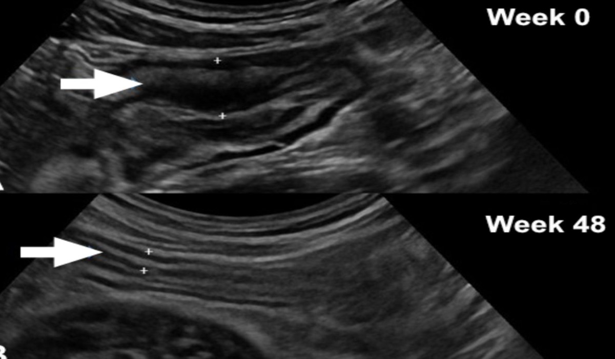 درمان قطعی ورم معده و روده