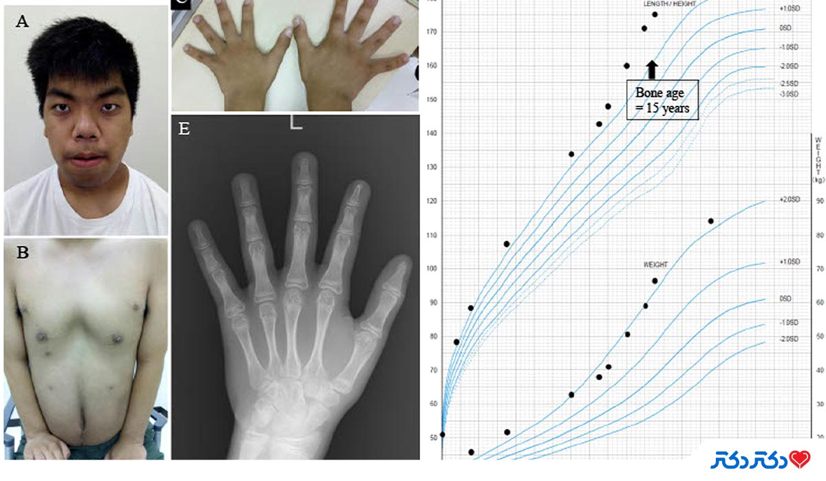 تشخیص بلوغ زودرس در پسران