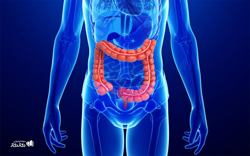 درمان کولیت