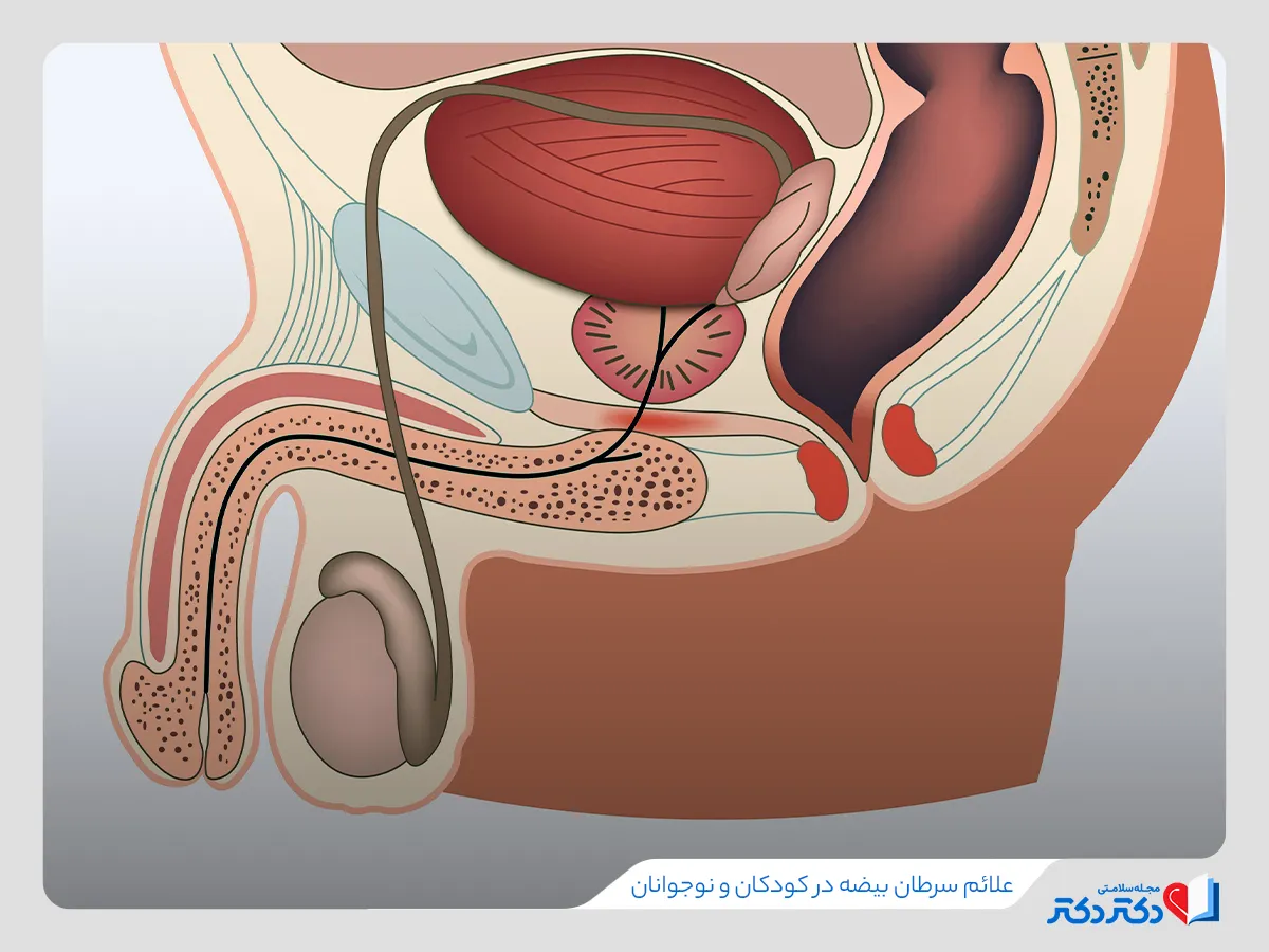 سرطان بیضه چیست و چه علائمی دارد؟ معارفه روش های تشخیص و درمان_رنگو 32 تصویر شماتیک علائم سرطان بیضه برای کودکان