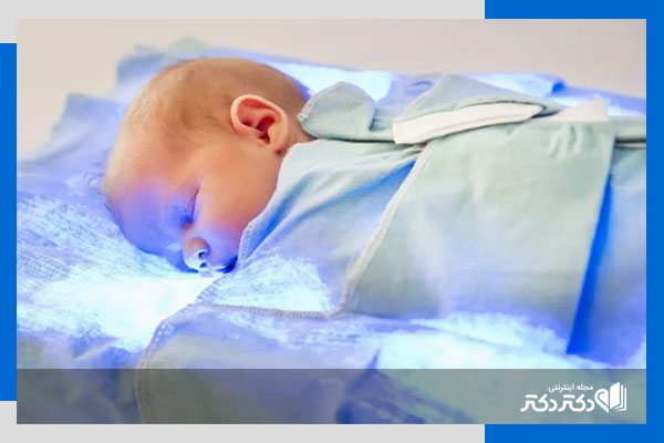 زردی چشم در کودکان و بزرگسالان نشانه چیست؟_رنگو 20 علت زردی چشم نوزاد در یک ماهگی