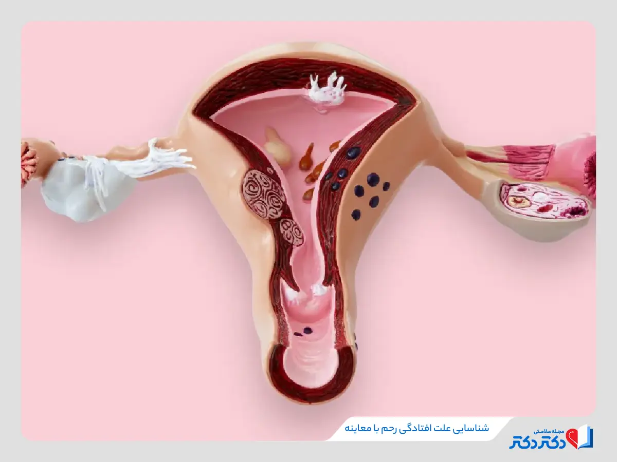 افتادگی رحم پرولاپس رحم علت افتادگی رحم_رنگو 32 درمان پرولاپس با شناسایی علت افتادگی رحم