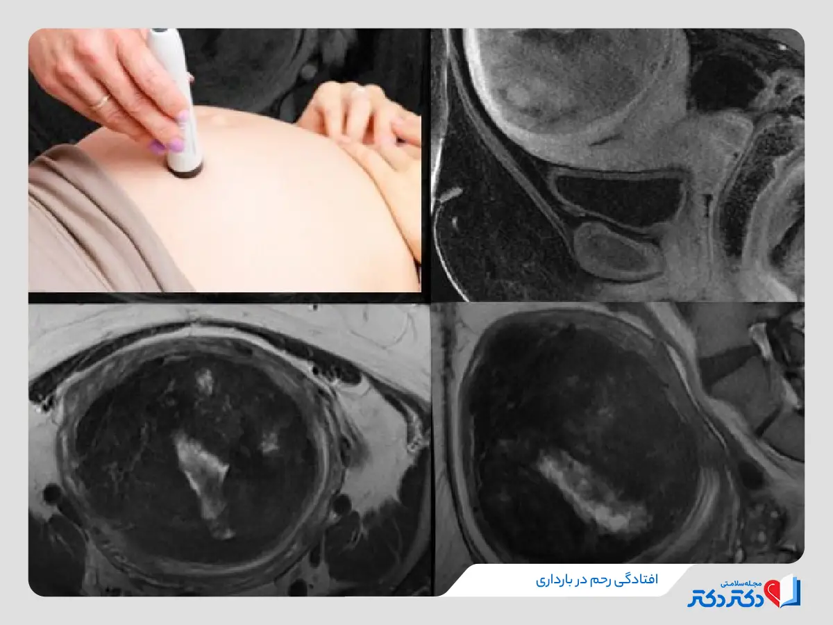 افتادگی رحم پرولاپس رحم علت افتادگی رحم_رنگو 30 افتادگی رحم در دوران بارداری