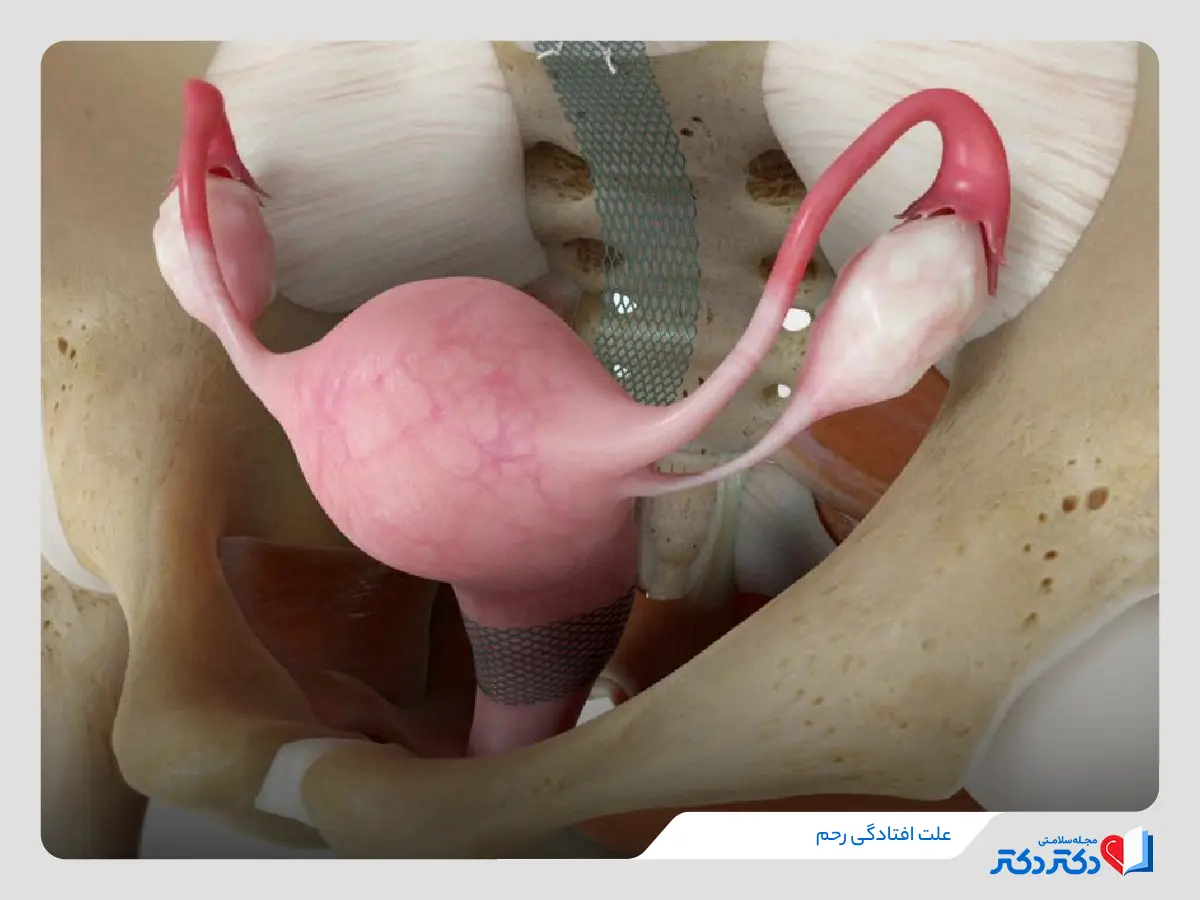 افتادگی رحم پرولاپس رحم علت افتادگی رحم_رنگو 28 افزایش سن و زایمان علت افتادگی رحم