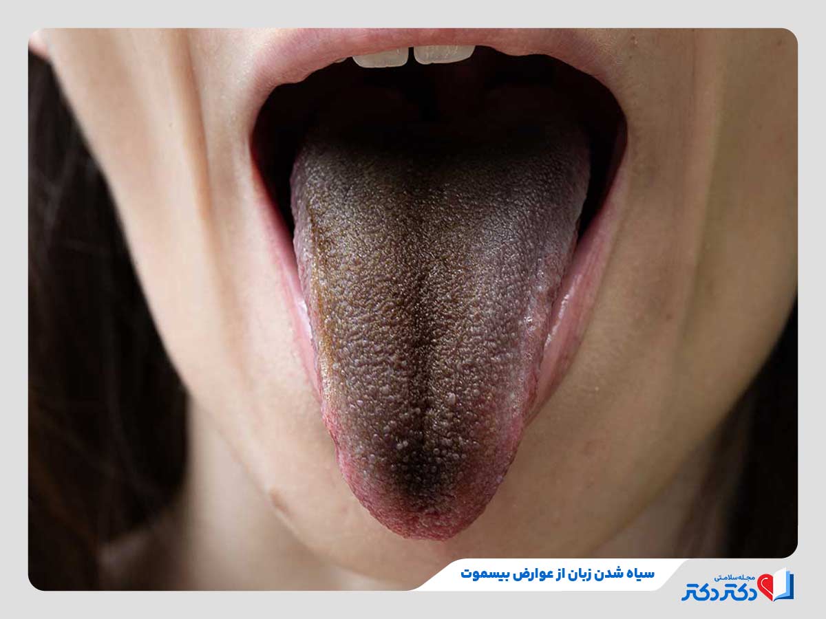 بازدید تاثییر قرص بیسموت روب اختلالات گوارشی + نحوه مصرف_رنگو 20 سیاه شدن زبان از شایعترین عوارض مصرف قرص بیسموت