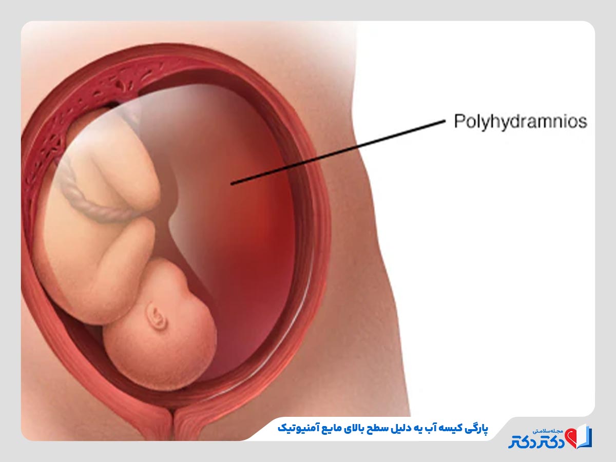 علت پارگی کیسه آب جنین چیست؟ چطور از پارگی آن پیشگیری کنیم؟_رنگو 22 زیاد بودن مایع آمنیوتیک از عوامل اصلی پارگی کیسه آب جنین