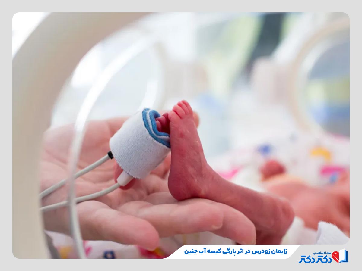 علت پارگی کیسه آب جنین چیست؟ چطور از پارگی آن پیشگیری کنیم؟_رنگو 20 زایمان زودرس از خطرات پارگی کیسه آب جنین