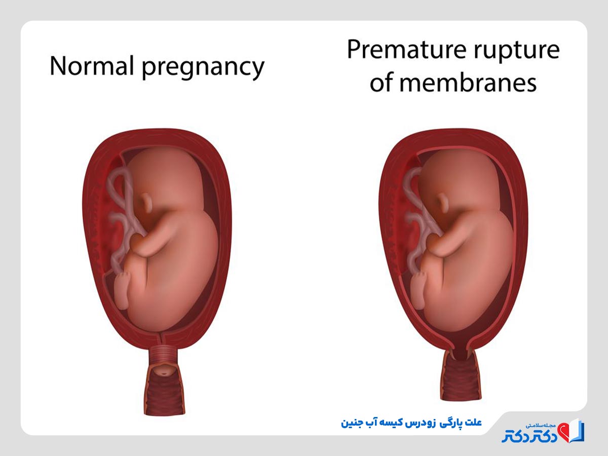 علت پارگی کیسه آب جنین چیست؟ چطور از پارگی آن پیشگیری کنیم؟_رنگو 18 عوامل تاثیرگذار بر پارگی کیسه آب جنین