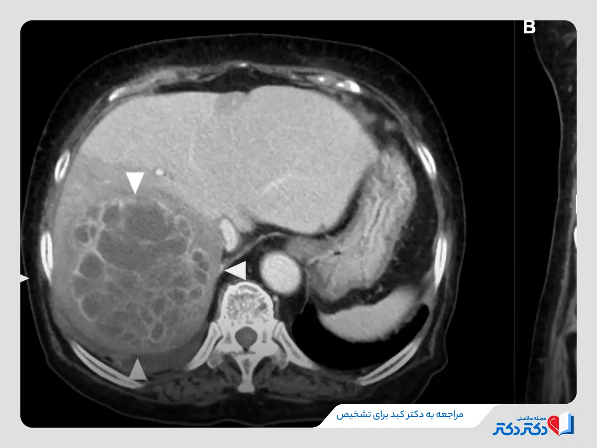 آبسه کبدی چیست و چه علائمی دارد؟ + بازدید دلایل عفونت کبدی_رنگو 22 عکس از کبد دچار آبسه و چرک
