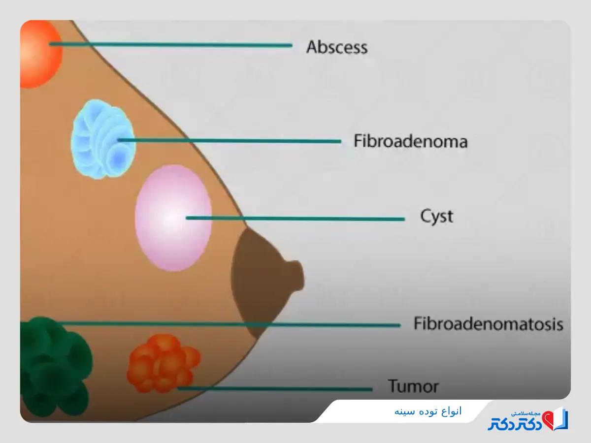 توده سینه چند نوع دارد؟ بازدید کامل علت غده در سینه زنان_رنگو 28 انواع توده در سینه