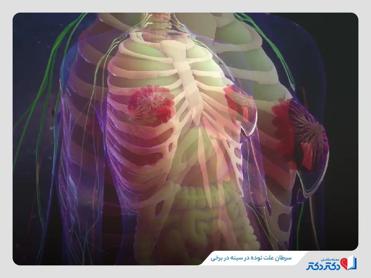 توده سینه چند نوع دارد؟ بازدید کامل علت غده در سینه زنان_رنگو 30 توده سرطانی در بافت پستان