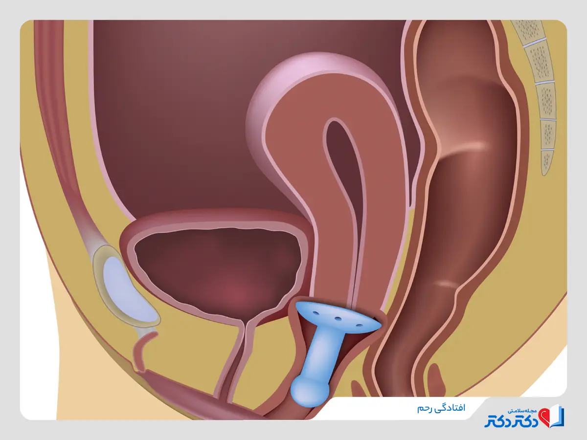 افتادگی رحم پرولاپس رحم علت افتادگی رحم_رنگو 24 افتادگی رحم یا پرولاپس رحم در لگن
