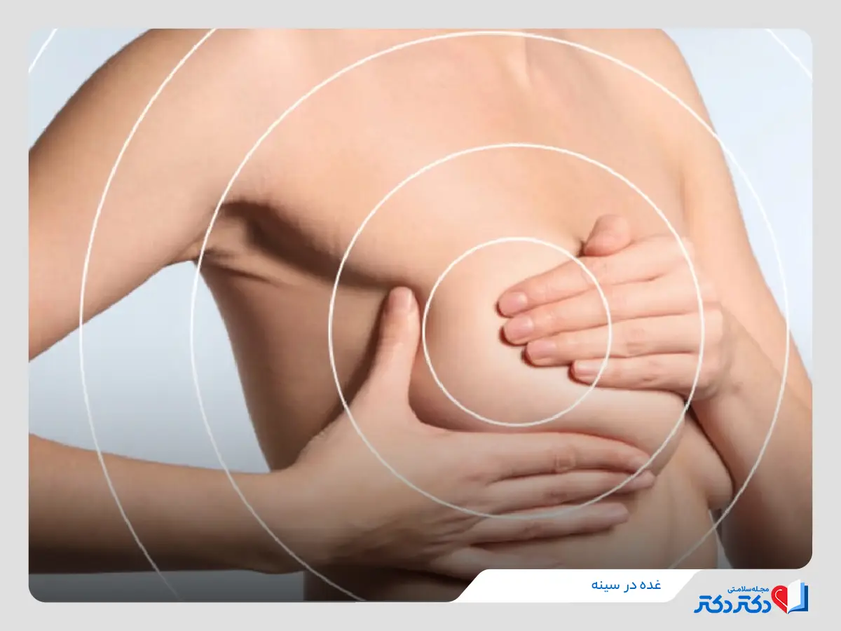 غده در سینه