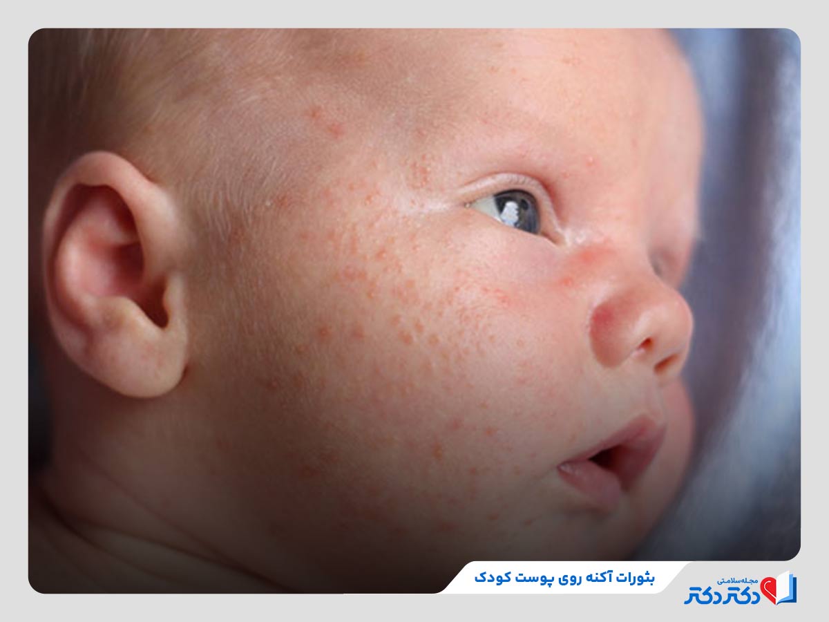 آکنه،‌اگزما، کهیر و بثورات پوستی چند علت حساسیت پوستی کودکان