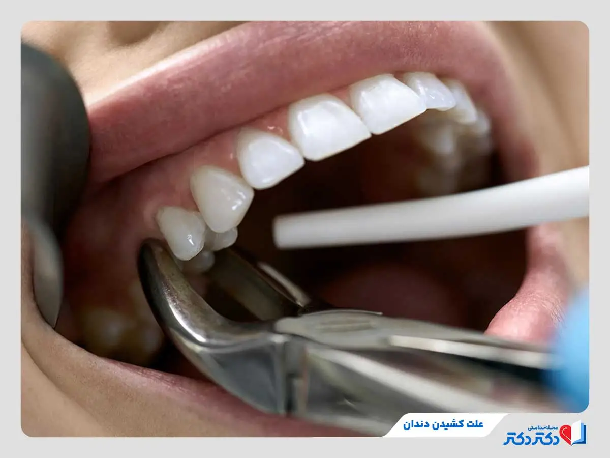 کشیدن دندان چه وقتی الزام اشکار میکند؟ + مرحله های کشیدن دندان_رنگو 2 علت کشیدن دندان، پوسیدگی شدید، عفونت، آسیبدیدگی یا موارد غیرقابلترمیم است.