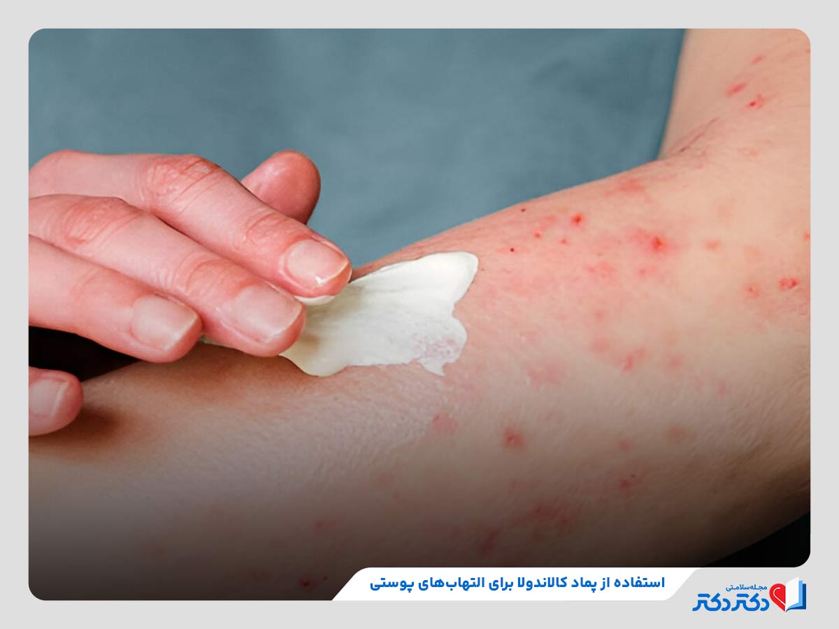 پماد کالاندولا چیست و چه کاربردی دارد؟_رنگو 18 استفاده از پماد کالاندولا به منظور کاهش علائم اگزما و درماتیت تماسی