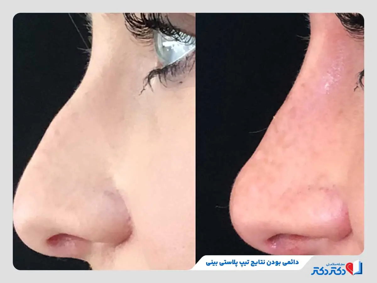 تیپ پلاستی بینی چیست؟ + انواع، مزایا و عوارض جراحی نوک بینی_رنگو 4 دائمی بودن نتیجه تیپ پلاستی بینی در زن جوان