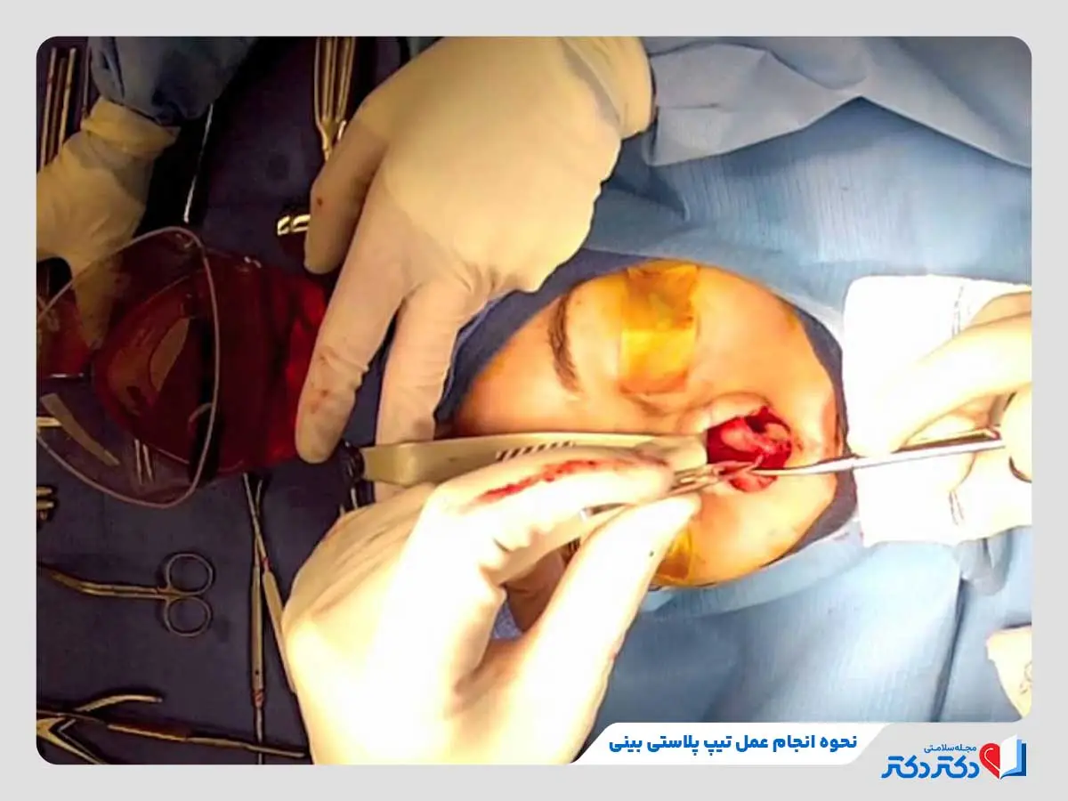 تیپ پلاستی بینی چیست؟ + انواع، مزایا و عوارض جراحی نوک بینی_رنگو 26 انجام عمل تیپ پلاستی بینی با ایجاد برشهای کوچک در داخل بینی