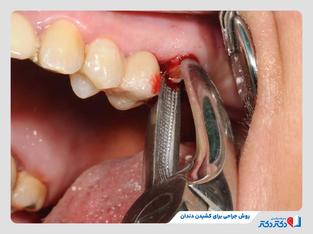 کشیدن دندان چه وقتی الزام اشکار میکند؟ + مرحله های کشیدن دندان_رنگو 6 انجام جراحی برای دسترسی بهتر و کشیدن دندان