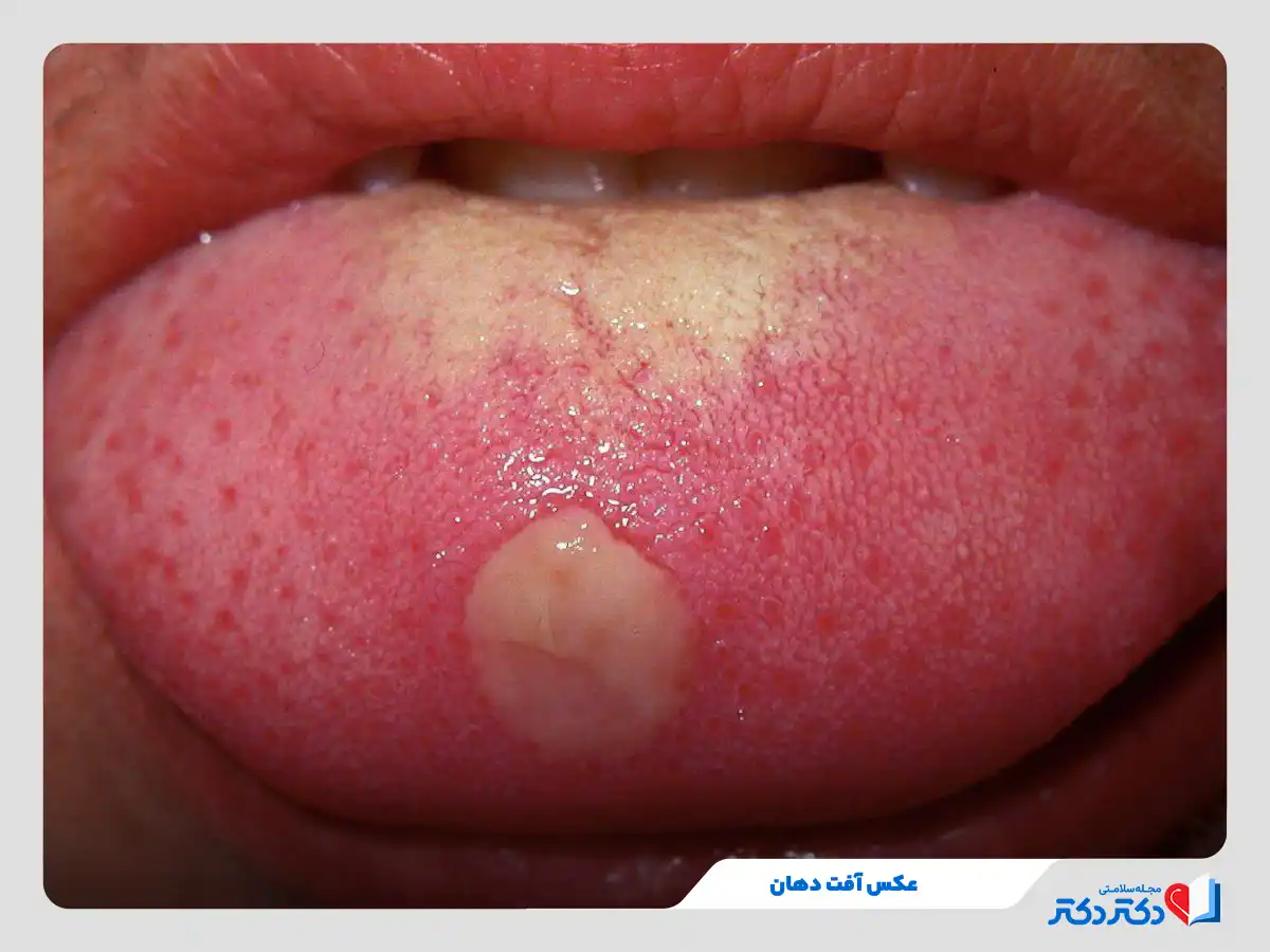 آفت دهان چیست و چه علتی دارد؟ + راه حلهای درمان آفت دهان_رنگو 22 استرس یک علت آفت دهان و بروز زخم سفید