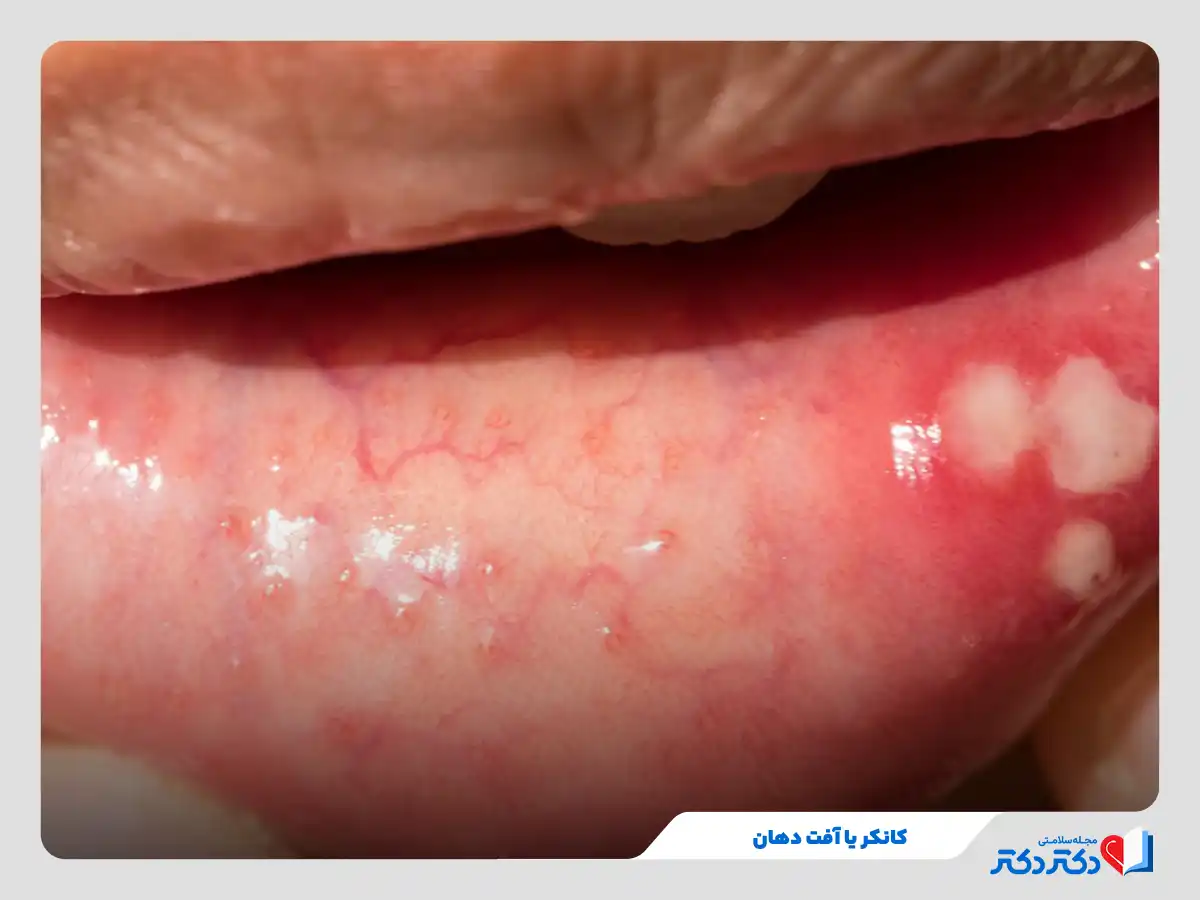 آفت دهان چیست و چه علتی دارد؟ + راه حلهای درمان آفت دهان_رنگو 26 زخم سفید با حاشیه قرمز آفت دهان